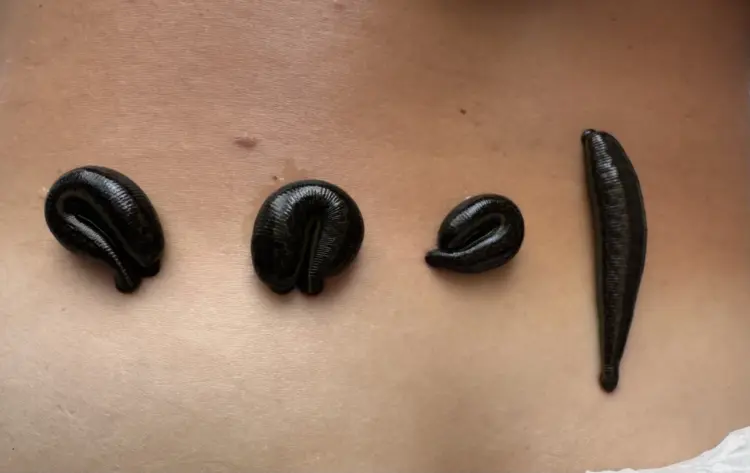 Blutegeltherapie (Hirudo-Therapie) Icon